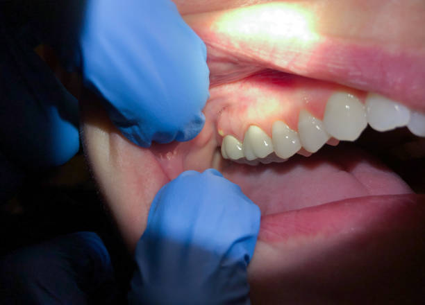 Best Emergency Wisdom Teeth Removal in Snellville, GA