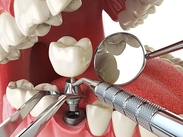 Best Emergency Broken Tooth Repair in Snellville, GA